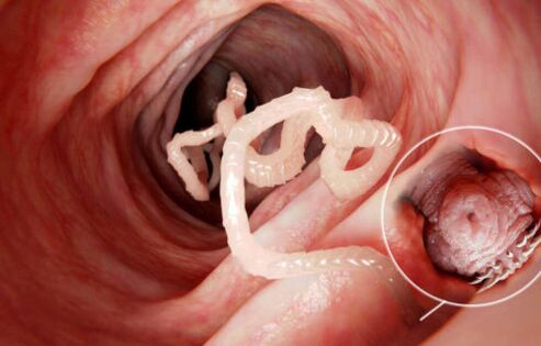 червеят е паразит в човешкото тяло