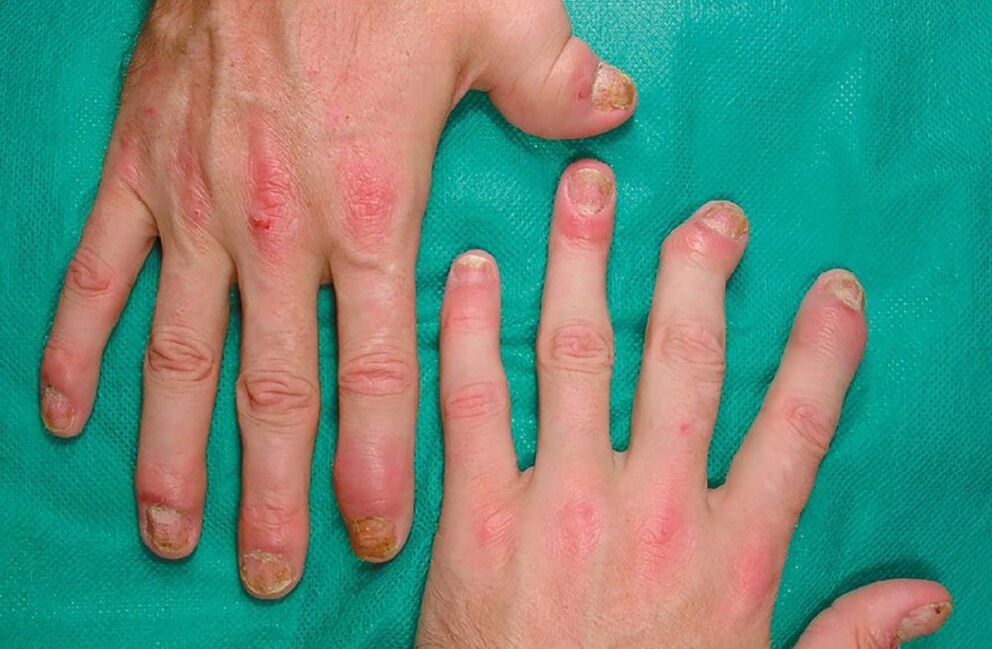 алергия с паразити в тялото