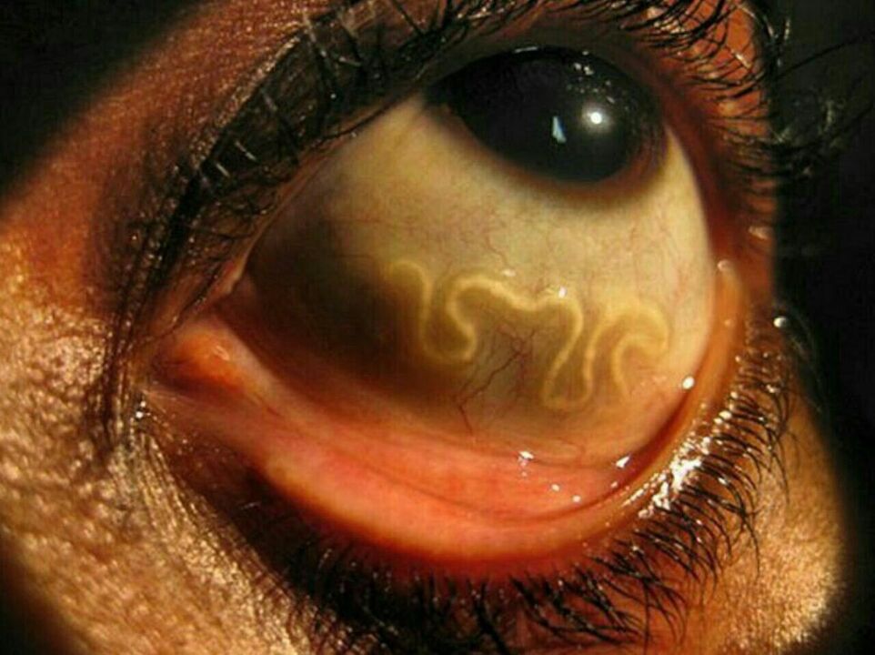 паразити в човешкото око